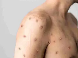 First case of new Mpox strain clade 1b detected in London